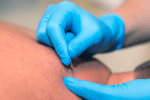 dry needling fysiotherapie
